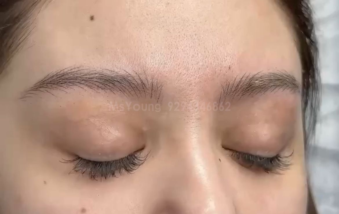 Stroke